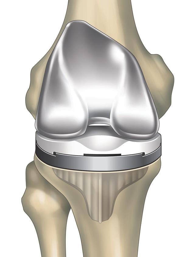 Procedures Total Knee Replacement Removal of damaged bone and cartilage from your