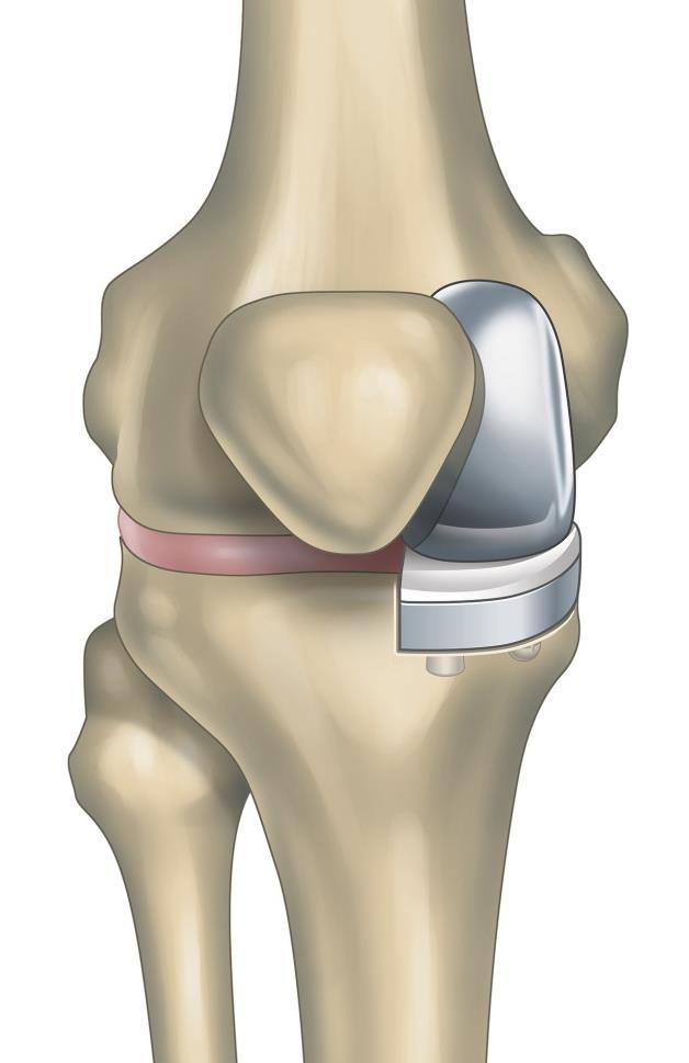 Procedures Unicondylar Knee Replacement