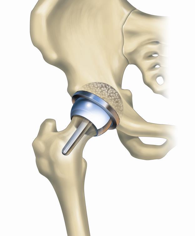 Procedures Hip Resurfacing Total ball is resurfaced and a