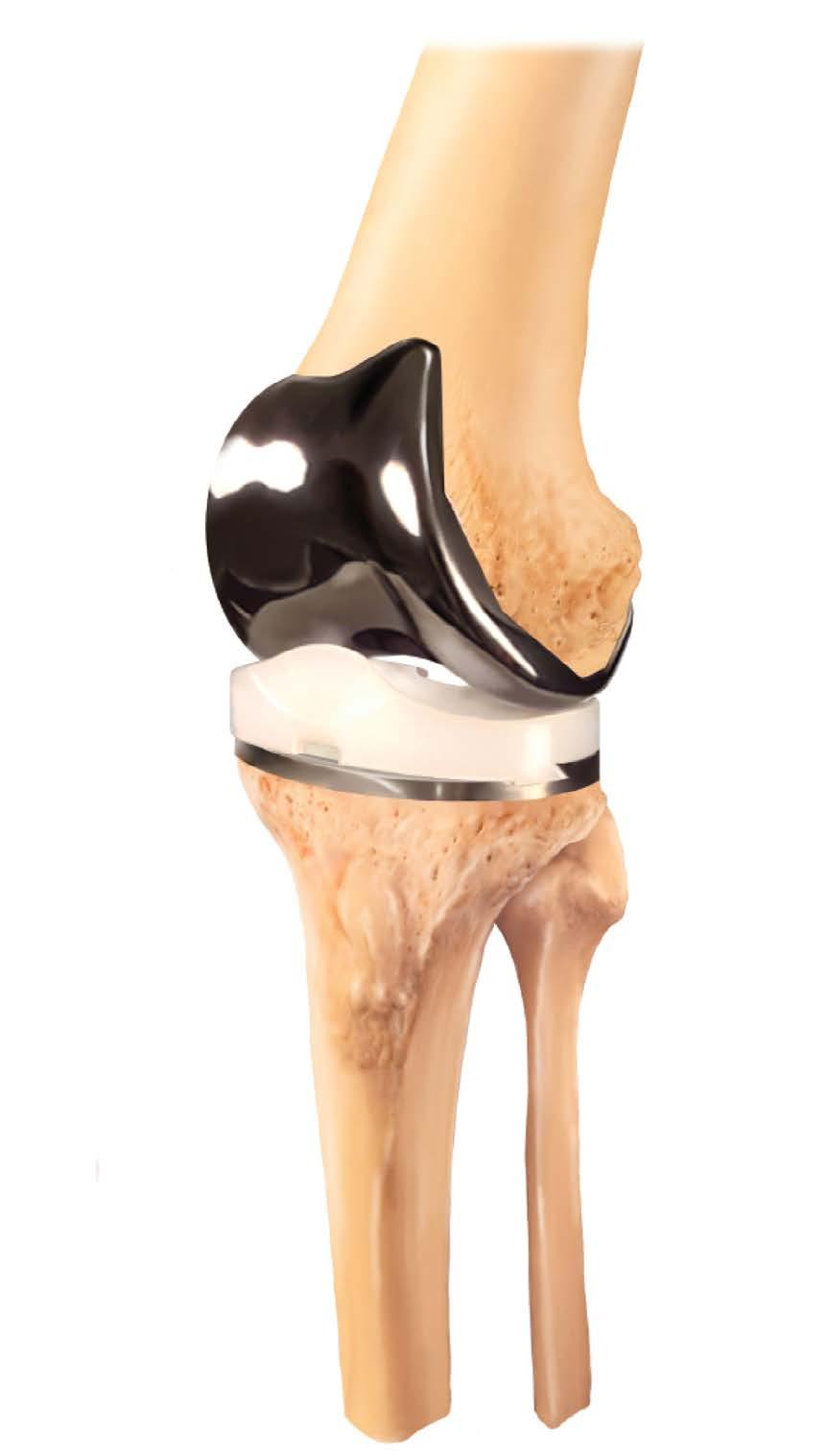 Your surgeon may elect to resurface the patella (kneecap) with a plastic prosthesis. The prosthesis will be held in place with cement.