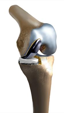 The unicompartmental replacement is a partial knee replacement that replaces only the side of the femur that has damage. This allows the surgeon to preserve the healthy bone in the knee.