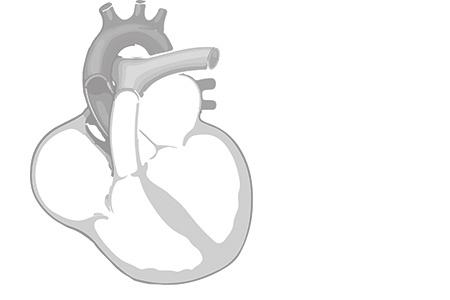 What is a lead? A cardiac lead is a special wire that sends energy from a pacemaker or implantable cardioverter defibrillator (ICD) to the heart muscle. What is a lead extraction?