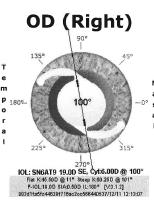 Confusion on Preop Axis Management of Regular Astigmatism Example Preop Steep Axis OD K s = 101o Pentacam =
