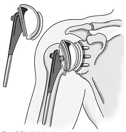 TOTAL SHOULDER ARTHROPLASTY When shoulder replacement surgery is performed, the ball is removed from the top of the humerus, or your upper arm bone, and replaced with a metal implant.