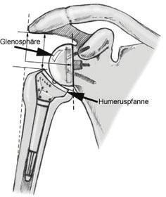 The socket portion of the joint, or your glenoid fossa, is shaved clean and replaced with a plastic socket that is cemented into the scapula. The scapula is what you would call your shoulder blade.