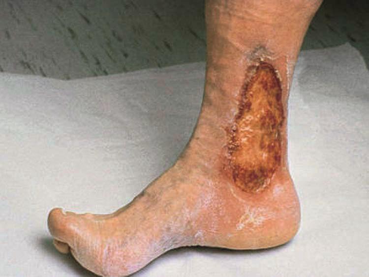 2.2 VLU treatment pathways VLUs are mainly caused by poor blood circulation in the leg. An example of a venous leg ulcer is presented in Image 1.