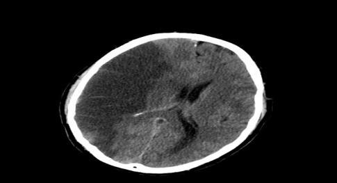 Stroke Measure OP 23: ED Head CT or MRI Scan Results for Acute Ischemic Stroke or Hemorrhagic Stroke who Received Head CT or MRI Scan Interpretation within 45 minutes of Arrival.