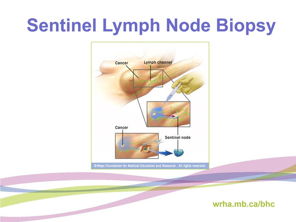 A sentinel lymph node biopsy involves injecting radioactive fluid or blue dye or both into the breast tissue surrounding the tumor.