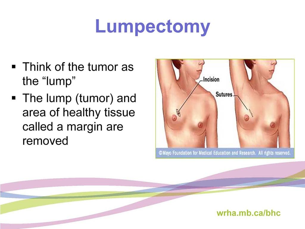 Lumpectomy surgery may also be referred to as breast conserving surgery. Think of the tumor as the lump within your breast.