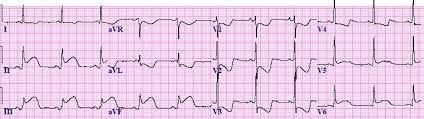 Clinical Case 1 Pre- notification STEMI 40 year old female Presents to Rural Urgent Care Centre at 0940 AV Rural Clinician pre-notifies ARV ARV