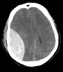 Clinical Case 3 Triple Zero call Neurosurgical Time-critical 30 yo gentleman found in a gutter by bystander 2300 000 called and patient transferred to an urban district ED at 2330 Patient referred to