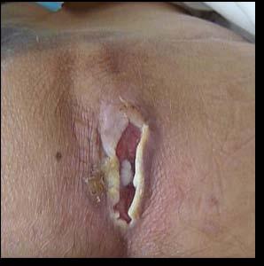 Ulcer Non - Removable