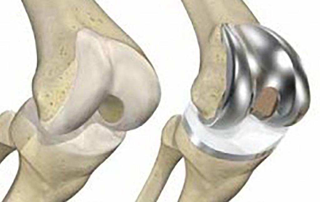 ARTHRITIS OF THE KNEE OR HIP OVERVIEW Arthritis of the knee or hip, also known as degenerative joint disease of the knee or hip, occurs when the protective cartilage on the ends of your bones wear
