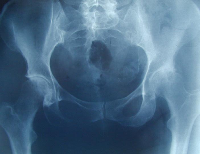 Total Hip Replacement In total hip replacement surgery, the portions of the hip joint that contain the damaged surfaces are replaced with precision metal and plastic parts accepted by the body which