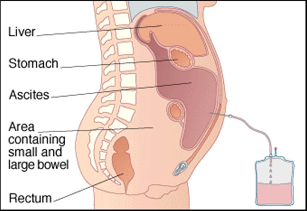 Paracentesis: A commonly performed procedure Over 500 paracenteses are performed