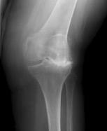 General Information Frequently Asked Questions About Total Knee Surgery We are glad you have chosen the Joint Replacement Center to care for your knee.
