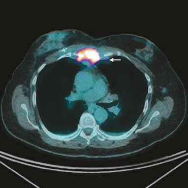 FDG PET/CT for recurrent breast cancer BY DR KHIMLING TEW, MBBS FRACS FRANZCR, CANBERRA IMAGING GROUP ASSOCIATE RADIOLOGIST A patient with a sterna mass from recurrent breast cancer and a sma ung
