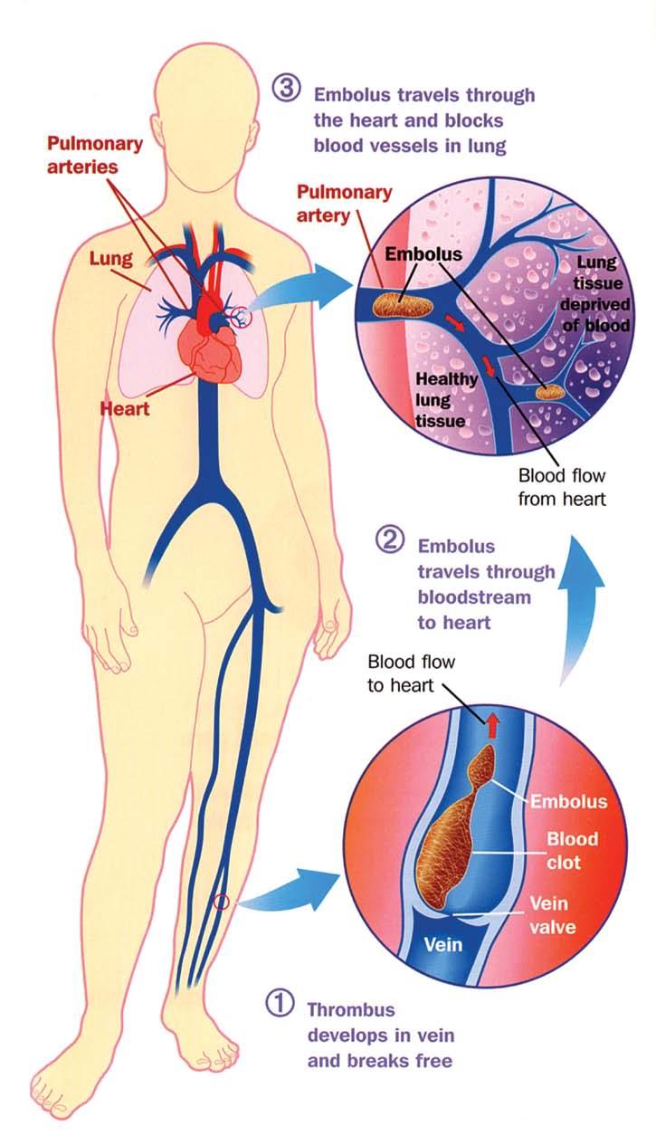 DVT (deep vein thrombosis) Deep vein thrombosis (DVT) is a common medical condition which occurs when a thrombus (blood clot) forms in a deep vein, usually in the leg or the pelvis.