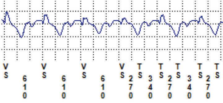DEVICE REPROGRAMMING T-wave or P-wave Oversensing If distinct T-waves or P-waves are marked as VS, FS, or TS: For T-waves marked as VS, FS, or TS, consider programming a longer decay delay period.