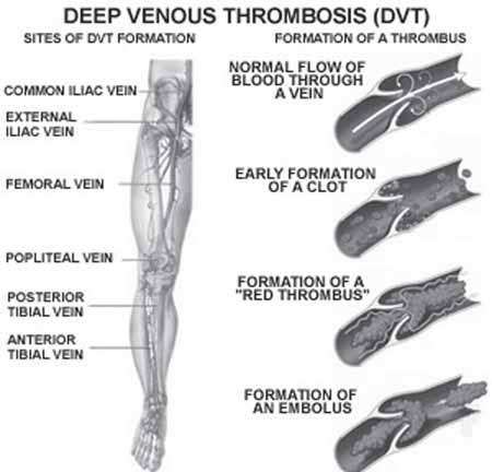 medsearch, cont d... A concerning complication associated with deep vein thrombosis is pulmonary embolism.