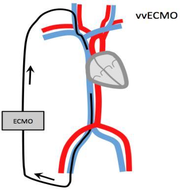 Indications for ECMO Respiratory failure (ARDS, pneumonia) Example