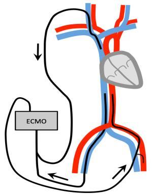 Indications for ECLS Combine Respiratory failure and Circulatory failure