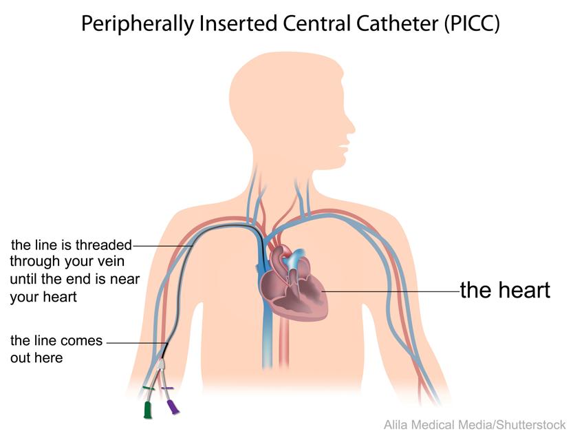 Information for patients: What is a PICC? A PICC is a peripherally inserted central catheter. It is a thin flexible tube that is inserted into a vein in the upper arm.