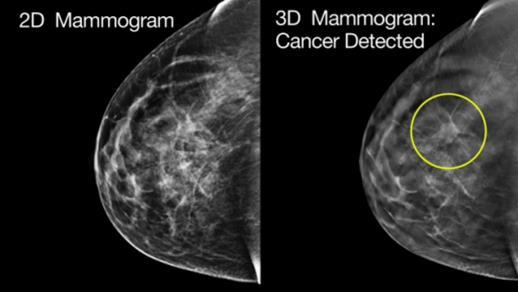 This brings the total ACR-accredited Mammography Systems in El Paso to six with UMC having four of those systems.