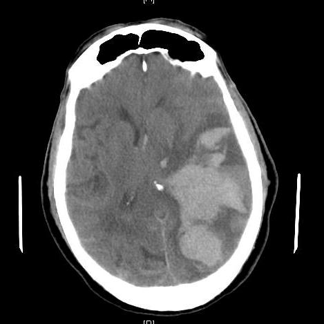 Improve Outcomes - Patients who sustain a head injury and are on an anticoagulant are at higher risk of having a traumatic intracranial hemorrhage (ICH) - ICH = Four to five fold higher fatality 1 -