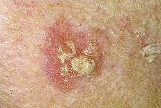 keratosis 10 Acne vulgaris 6 Other atopic dermatitis 4