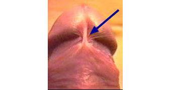 Patient Information Department of Urology 03/Urol_04_14 Lengthening of the penile frenulum (frenuloplasty): procedure-specific information What is the evidence base for this information?