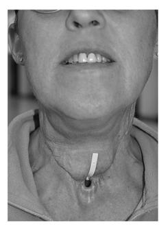 Page 3 This patient had her larygectomy surgery 1 year ago. She has a tracheo-esophageal puncture (TEP) in place for speech. stomach through the feeding tube.