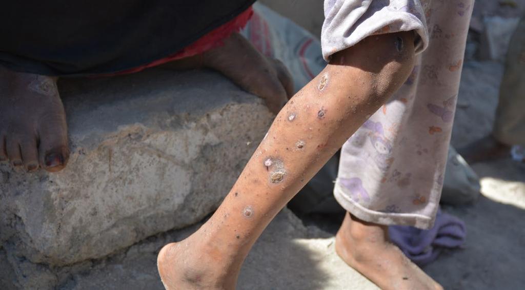 39 Neglected tropical diseases (NTDs) are commonplace in IDP camps.