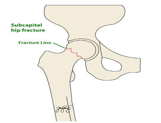 Subcapital Fracture: This fracture happens below the femoral head (the ball) and can damage the blood supply