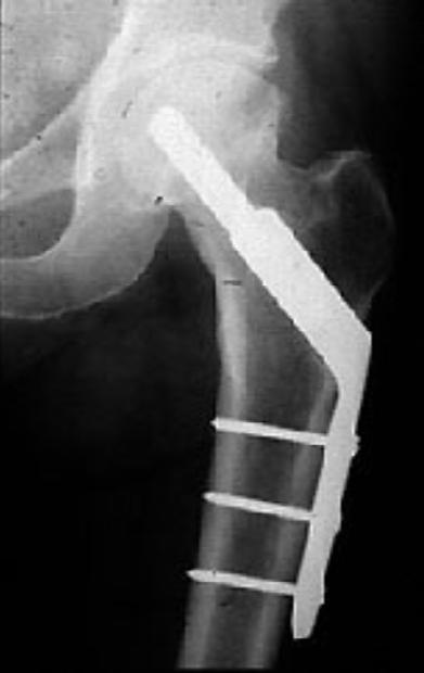 Intertrochanteric fracture: This fracture happens further down the femur This operation involves fixing a metal plate to the side of the femur