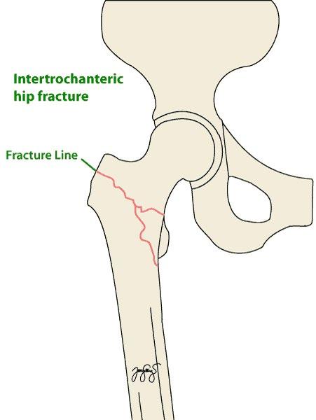 There are other operations that can be carried out for these fractures but these are the most common Before you have your operation, the