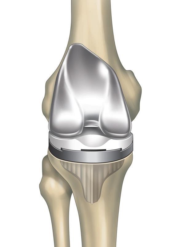 Total Knee Replacement Removal of the damaged bone and cartilage from your thigh bone (femur), shin