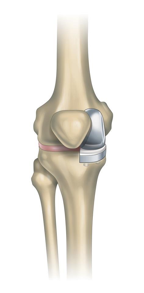 Partial Knee Replacement Removal of only half of the knee (affected side)