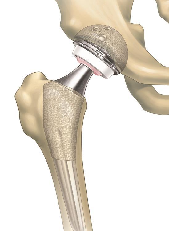 Total Hip Replacement Removal of the damaged bone and cartilage from your thigh bone