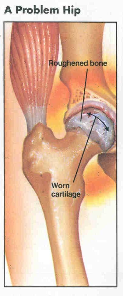 The cartilage allows the ball to glide easily inside the socket and provides a cushion to your hip joint. Muscle and ligaments hold the hip joint in place.