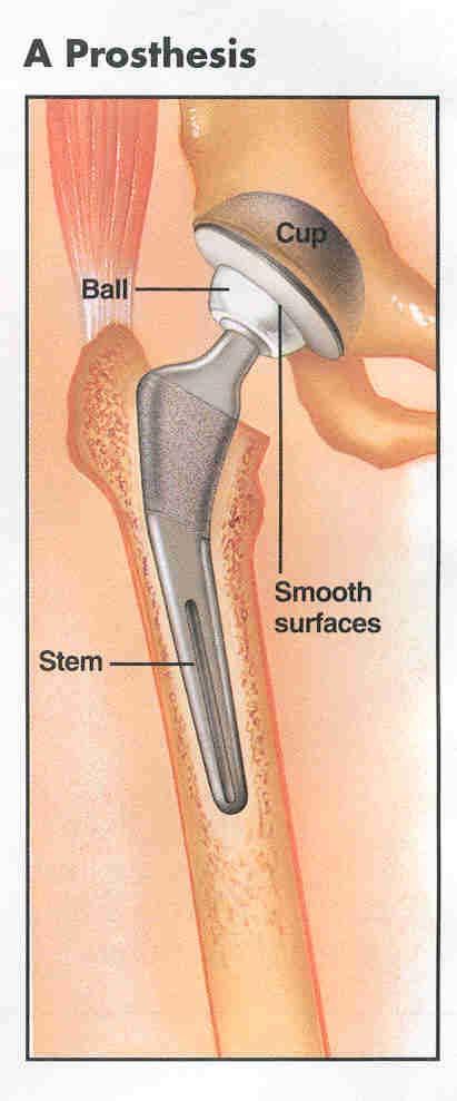 A PROSTHETIC HIP (YOUR NEW HIP) A total hip replacement is a surgical procedure whereby the diseased cartilage and bone of the hip joint is surgically replaced with artificial materials.