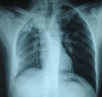 India Evaluation of Another Pulmonary TB Case Fairfield 4/07 India CXR report 11/06: R upper zone infiltrate w/ R CP blunting Clinical assessment 11/06: I certify he is fit for travel to US Fairfield