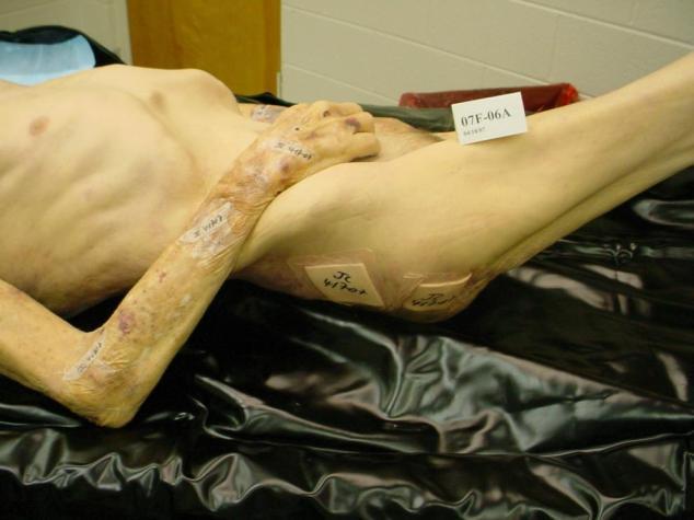 Autopsy Photo of Resident Sentencing George Houser was found Guilty on all counts one count of conspiracy to commit Health Care Fraud and 10 tax