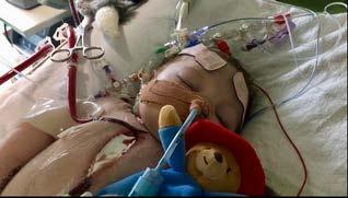 ECMO cannulae in baby s chest. Note the baby is on a ventilator.
