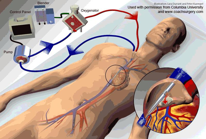 Journal How does ECLS work? ECLS supports the heart and/or lungs by continuously pumping some of the patient s blood out of their body to an oxygenator (artificial lung).