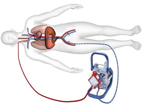 Journal Veno-venous ECLS Veno-venous (VV) ECLS is used for lung support only. For veno-venous ECLS, one or two cannulas are placed in large veins.