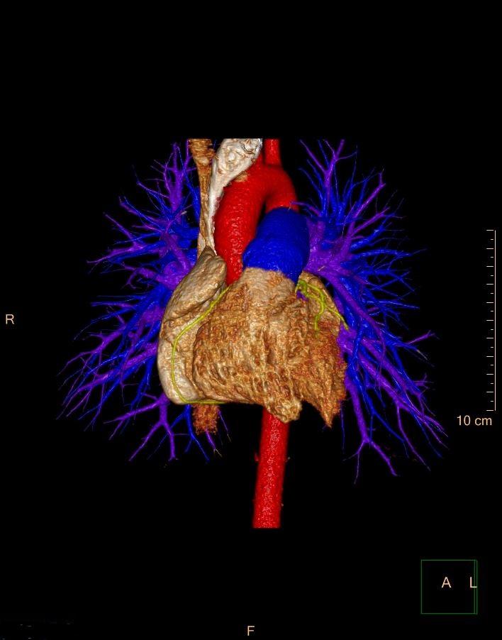 Cardiac CT: 3D