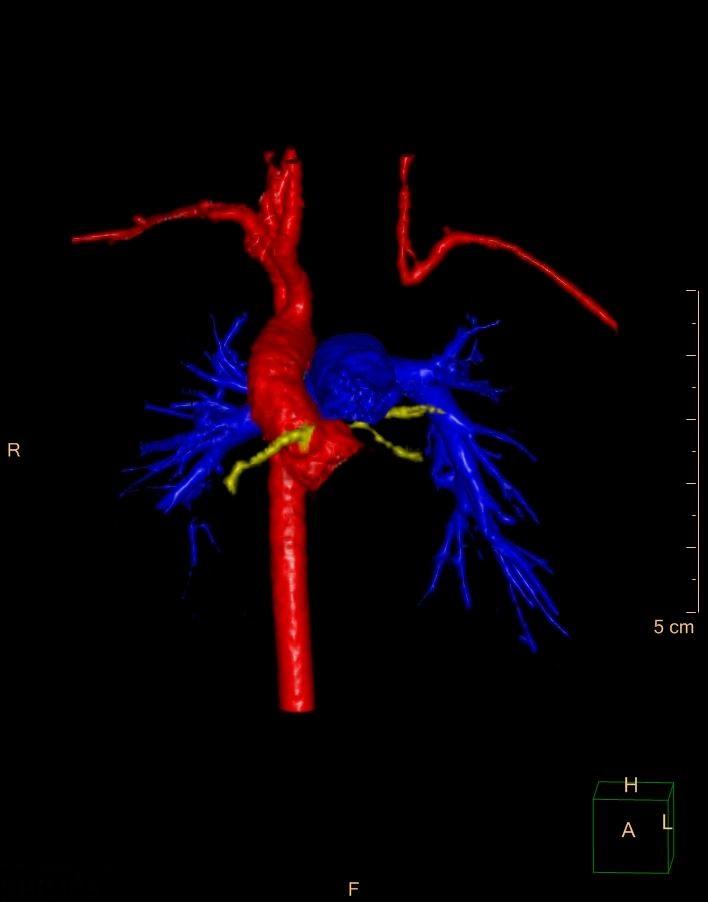 Cardiac CT: 3D with color coding: