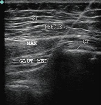 ( ) Ultrsound imge shows the sucutneous tissues ( ST ), gluteus mximus ( MAX ), gluteus medius ( GLUT MED ), nd the greter trochnter ( GT ).