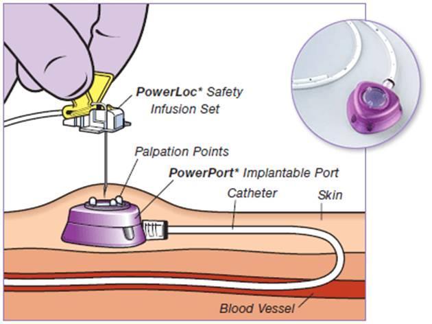 IMPLANTED PORTS Surgically inserted for long term dwell capacity for ongoing infusion therapies such as chemotherapy; requiring little maintenance when not in use Used in Chronic illnesses with